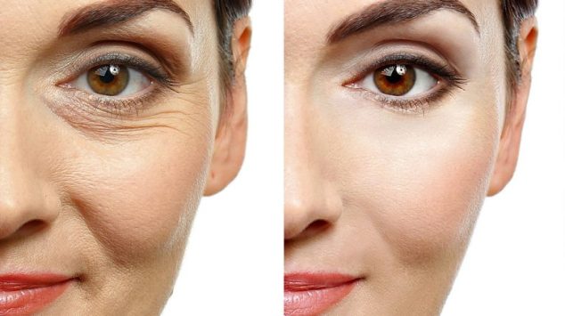 Is Botox A Temporary Fix For The Wrinkles On Your Skin?