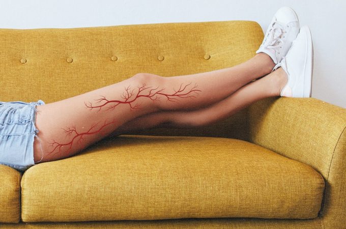 Varicose Veins Cannot Be Cured But Can Be Treated Now